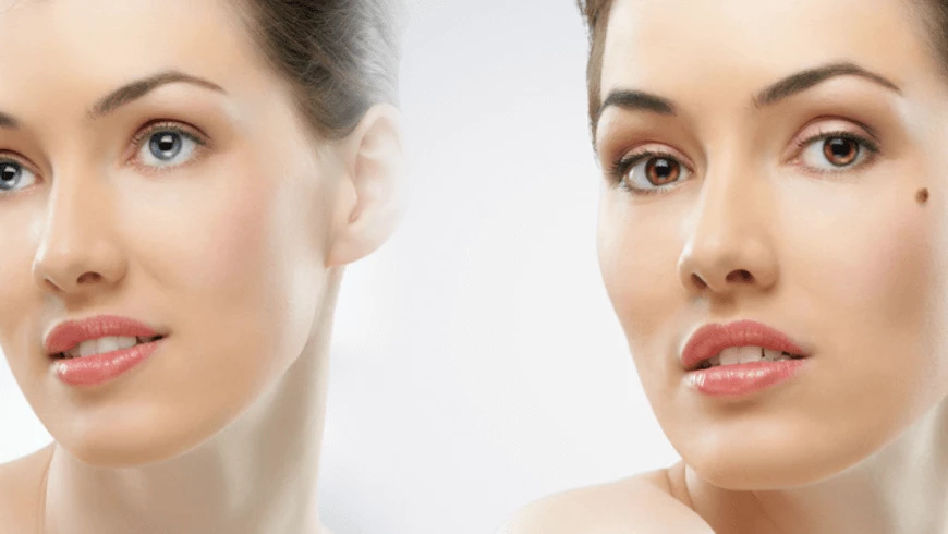 MOLE REMOVAL